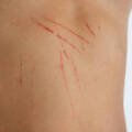 Unexplained Scratches? Demonic Scratches: When Evil Leaves Its Mark On Your Body